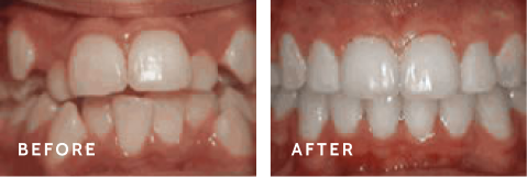 Before after photos of front teeth before and after Crowding of the teeth procedures