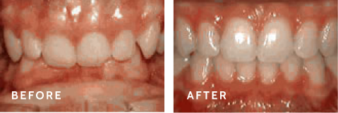 Before after photos of front teeth before and after Deep overbite procedures
