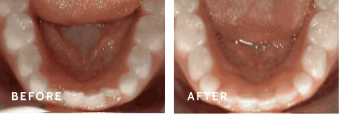 Before after photos of front teeth before and after Non-braces treatment procedures