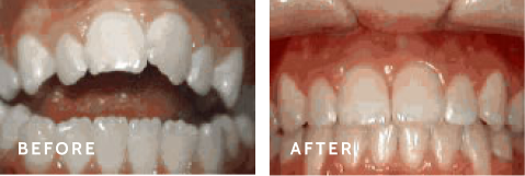 Before after photos of front teeth before and after Open bite procedures