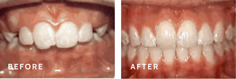 Before after photos of front teeth before and after Overjet procedures
