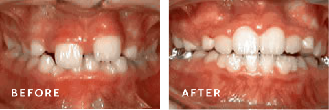 Before after photos of front teeth before and after Phase One procedures
