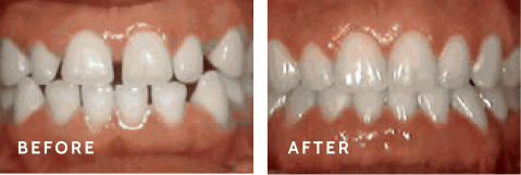 Before after photos of front teeth before and after Spacing of teeth procedures