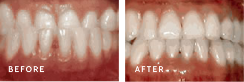 Before after photos of front teeth before and after Underbite procedures