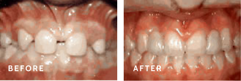 Before after photos of front teeth before and after lateral incisors procedures