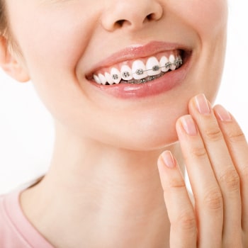 Smile with Self-Ligating Braces
